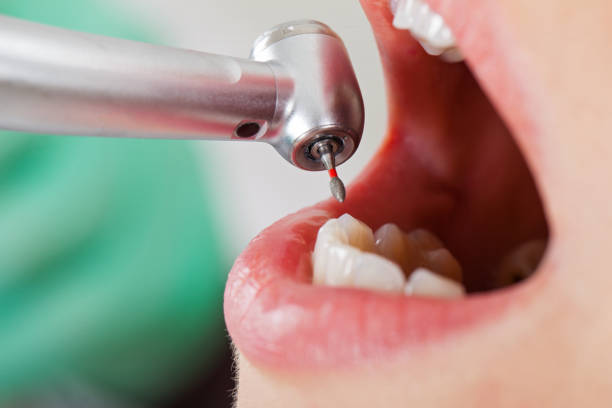 Best Knocked-Out Tooth (Avulsed Tooth) Treatment in Juno Beach, FL
